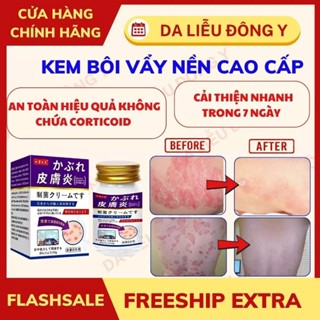 [Chính Hãng] Kem Bôi Da Liễu Cao Cấp Nakusa Nấm Hắc Lào Vẩy Nến Á Sừng Tổ Đỉa diện rộng 55g