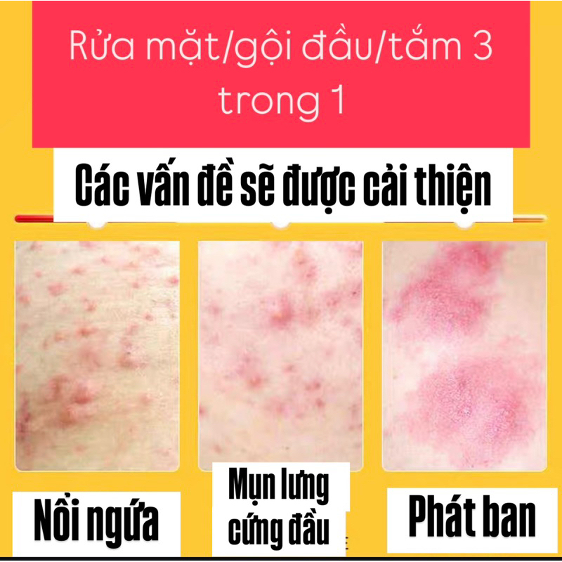 Sữa Tắm Gội 3 in 1 Giảm Mụn Lưng, Giảm Viêm Nang Lông, Sạch Thâm Đồng Nhân Đường- Giảm Ngứa, Kháng Khuẩn 400ML