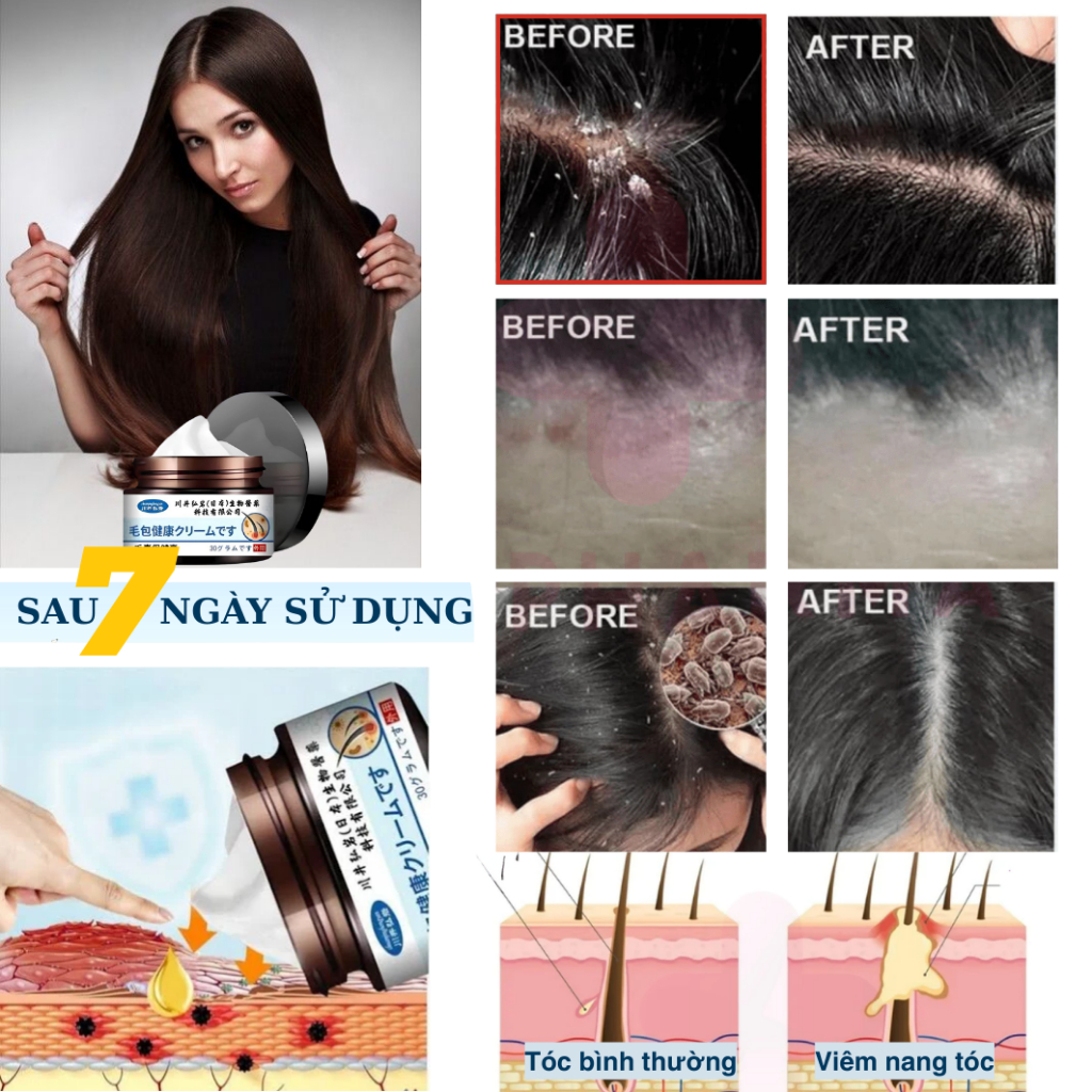 Kem Bôi Viêm Nang Tóc Sakaido 30g – Giảm Ngứa, Loại Bỏ Viêm Nang Tóc, Sạch Gàu, Vảy Nến,Dưỡng Da Đầu Khoẻ Mạnh | BK INNO