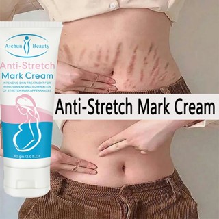 Kem Rạn Da Anti Stretch 60g - Giảm Rạn Cũ, Ngừa Rạn Mới, Dưỡng Ẩm, Mờ Thâm Rạn An Toàn Cho Mẹ Bầu