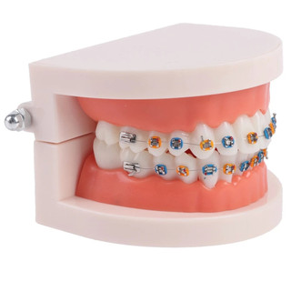 Mẫu Hàm Tư Vấn Chỉnh Nha - Mẫu Hàm Tư Vấn Gắn Mắc Cài
