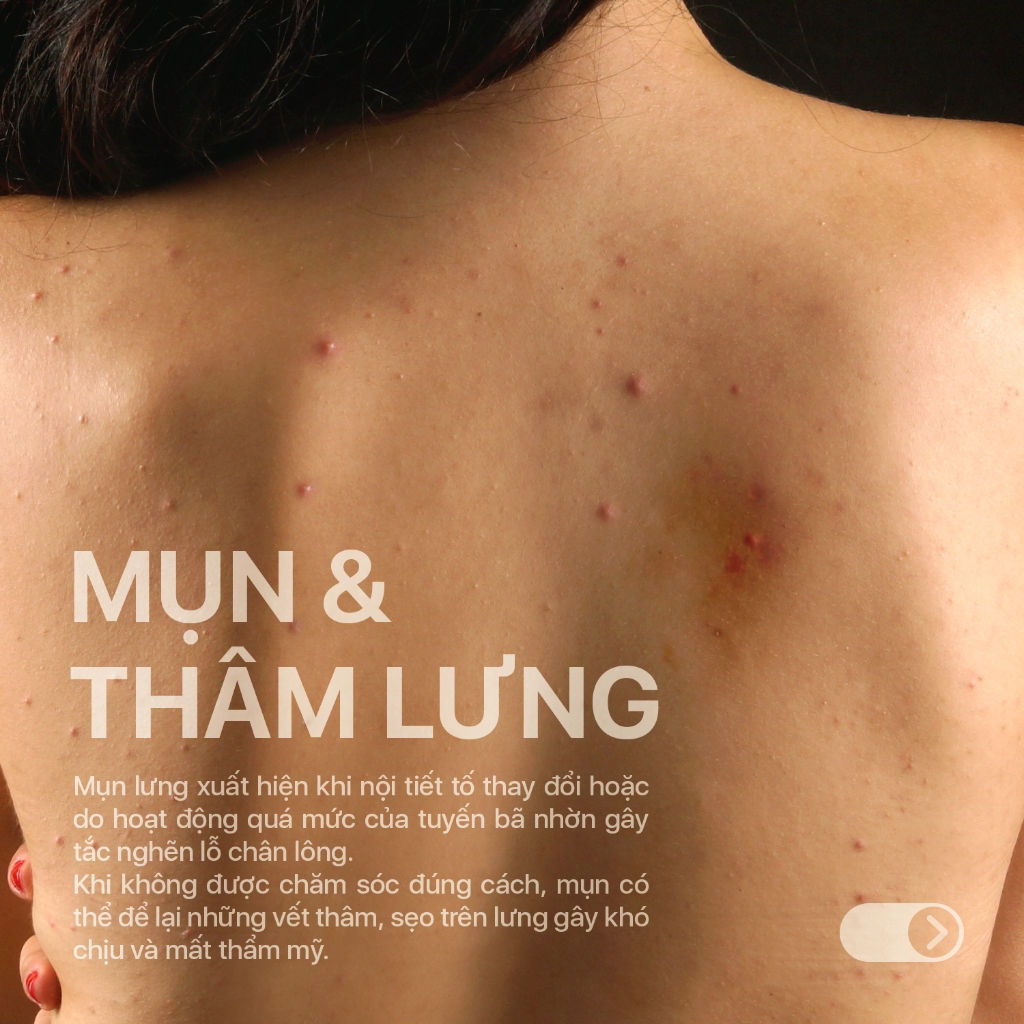 Xịt giảm mụn lưng, giảm viêm nang lông Neoacnes sạch mụn, mờ thâm giảm viêm 100ml | BigBuy360 - bigbuy360.vn