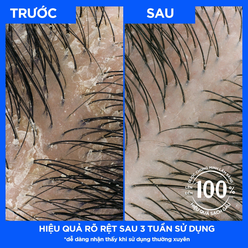 Dầu Gội Và Xả 2in1 Sạch Gàu HEAD & SHOULDERS Mỹ Sạch Sâu/ Dành Cho Da Đầu Khô/ Suôn Mượt/ Hương Nước Hoa - Chai 370ML | BigBuy360 - bigbuy360.vn