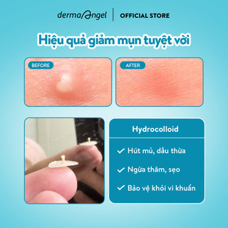 Combo Dán Mụn Day Plus (Salicylic Acid) & Mix Derma Angel