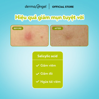 Combo Dán Mụn Day Plus (Salicylic Acid) & Mix Derma Angel