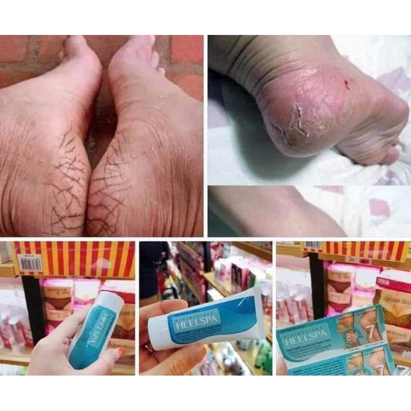 Kem Bôi Thoa Nứt Nẻ Gót Chân HeelSpa Thái Lan