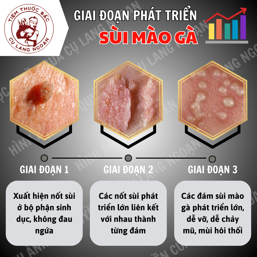 [Rụng sùi dứt điểm] Tinh chất chấm sùi mào gà Cụ Lang Ngoạn làm nhanh khô rụng sùi, mụn cóc, tránh tái lại lọ 10ml