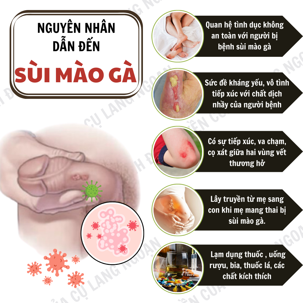 [Rụng sùi dứt điểm] Tinh chất chấm sùi mào gà Cụ Lang Ngoạn làm nhanh khô rụng sùi, mụn cóc, tránh tái lại lọ 10ml