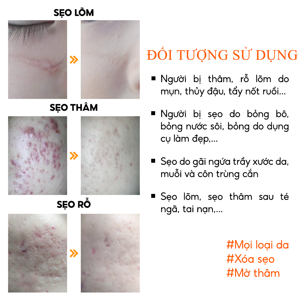 Kem Mờ Sẹo Nghệ Đỏ Scar Abera - Giúp Liền Sẹo Rỗ, Sẹo Lồi, Sẹo Lõm, Sẹo Sau Sai Nạn, Sẹo Bỏng ĐHBK Hà Nội Nghiên Cứu