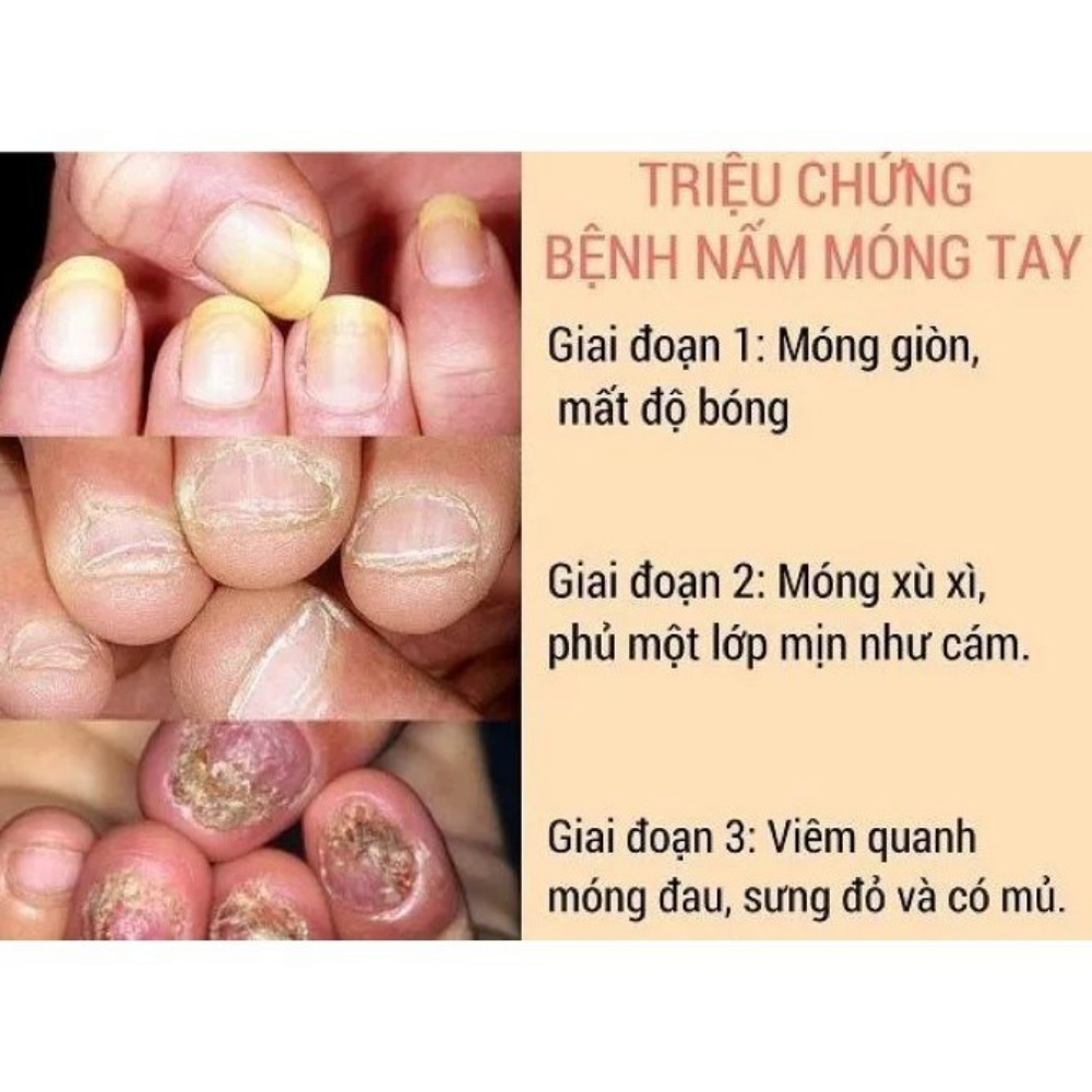 Tinh chất nấm móng Nhật Bản KANNEDO - KANNEDO tinh chất giảm nấm móng, hư móng, dưỡng móng dày chắc khỏe - MINT COSMETIC