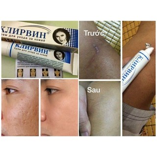 Kem Sẹo Nga Klirvin - Xóa sẹo, thâm, rạn da... hiệu quả, Giúp phục hồi các tổn thương trên da, thúc đẩy tái tạo da