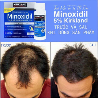 Dung Dịch Hỗ Trợ Mọc Râu Tóc Minoxidil 5%