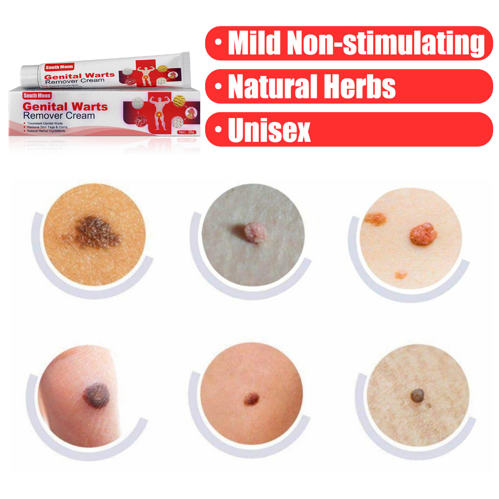 KEm bôi Genital Warts Sùi Mào Gà, Mụn Cóc, Mụn Cơm Vùng Kín Nam Nữ, hết ngứa ngay lập tức