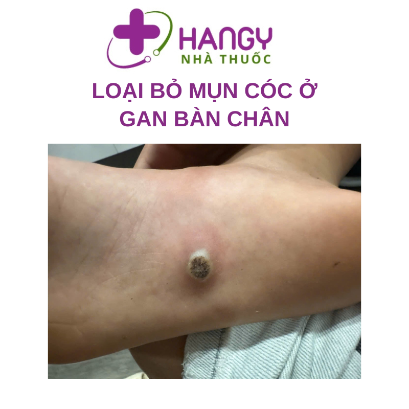 Gel bôi GENI-WA 20g giúp giảm sùi mào gà, mụn sinh dục do nhiễm HPV ngoài da và niêm mạc