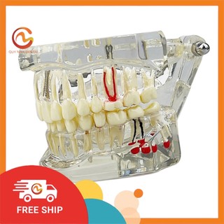 Mô hình rút răng thực hành nha khoa