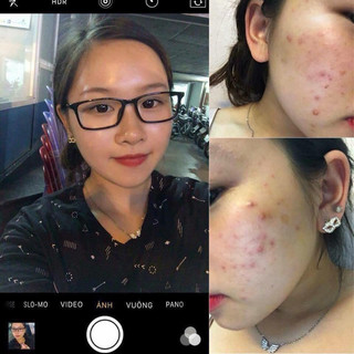 (mới cải tiến) serum chấm xẹp mụn-viêm- mũ-sưng đau - mờ thâm My Miu 10ml (chính hãng)