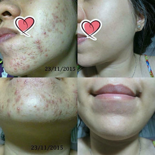 (mới cải tiến) serum chấm xẹp mụn-viêm- mũ-sưng đau - mờ thâm My Miu 10ml (chính hãng)