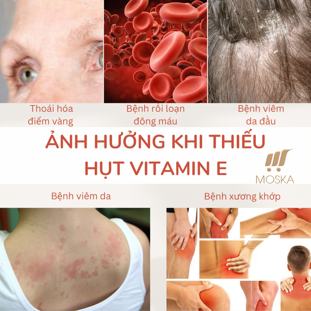 Viên Uống Vitamin E Đỏ Mirrolla Nga 400mg - Bổ Sung Dưỡng Chất, Tốt Cho Phụ Nữ 30 viên, Khoẻ Trong Đẹp Ngoài| Moska shop