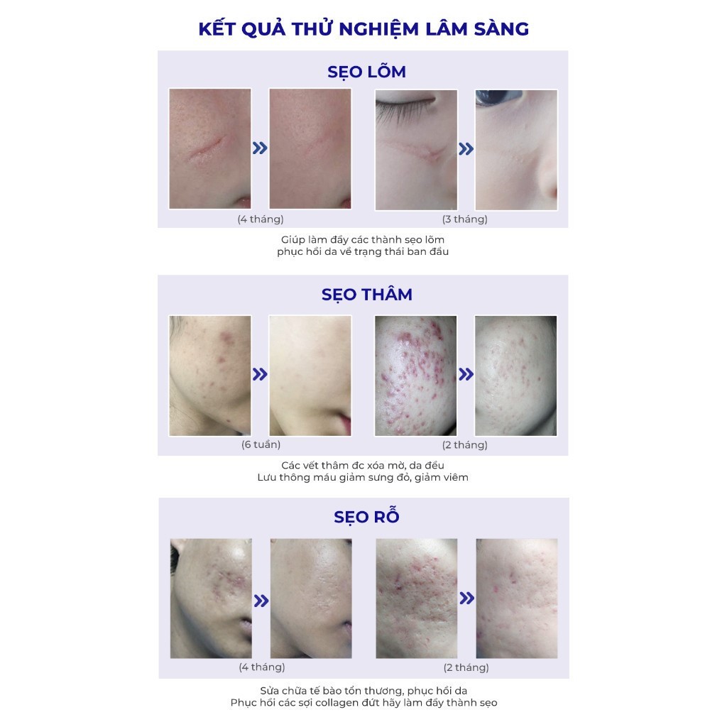 Kem làm mờ Sẹo Thâm/ Lấp đầy Sẹo Rỗ, Sẹo Lõm Scar Esthetique 10ml/30ml/60ml của Rejuvaskin