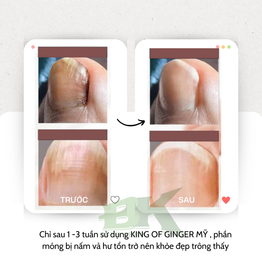 Tinh Chất Dưỡng Móng Tay, Chân Thảo Dược Gừng Già Xanh Nail Fungus EELHOE Mỹ Loại Bỏ Nấm Móng, Thối Bọng Móng, Hư Khóe
