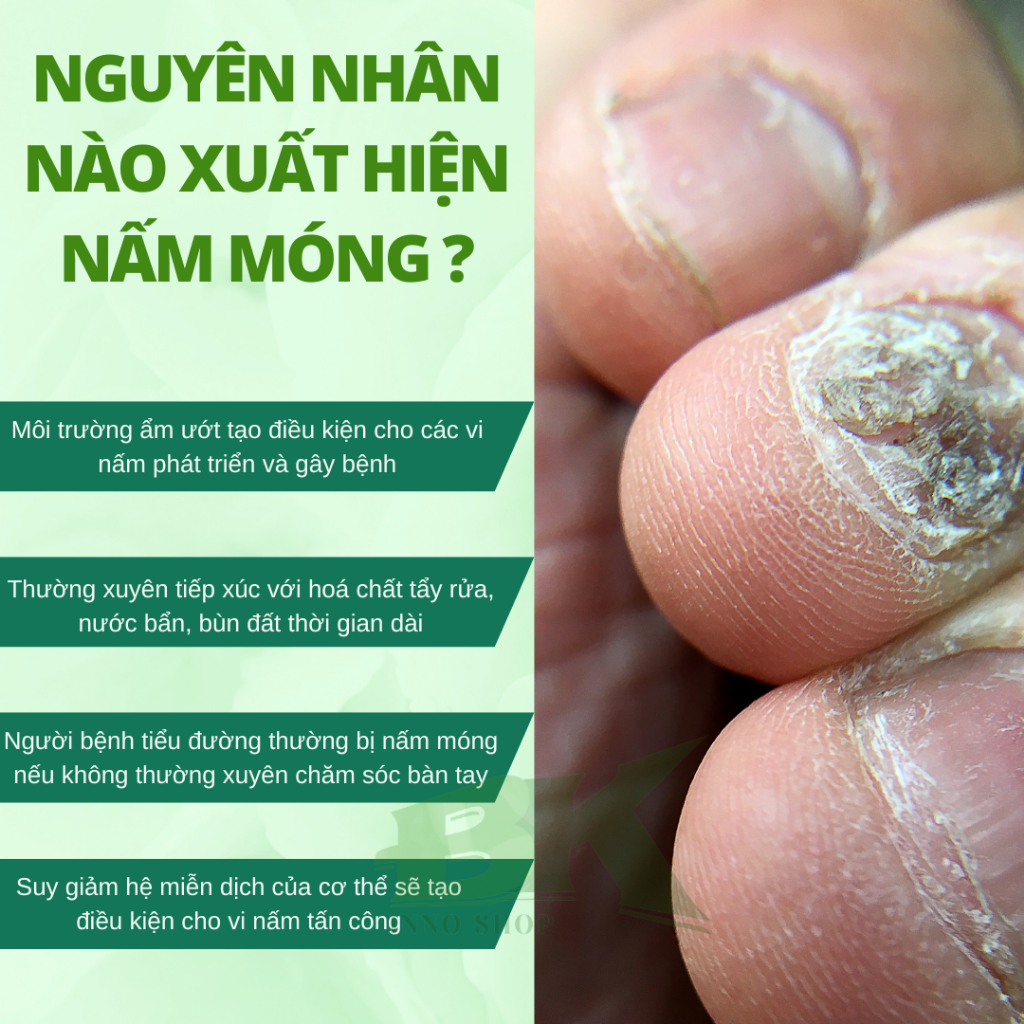 Tinh Chất Dưỡng Móng Tay, Chân Thảo Dược Gừng Già Xanh Nail Fungus EELHOE Mỹ Loại Bỏ Nấm Móng, Thối Bọng Móng, Hư Khóe