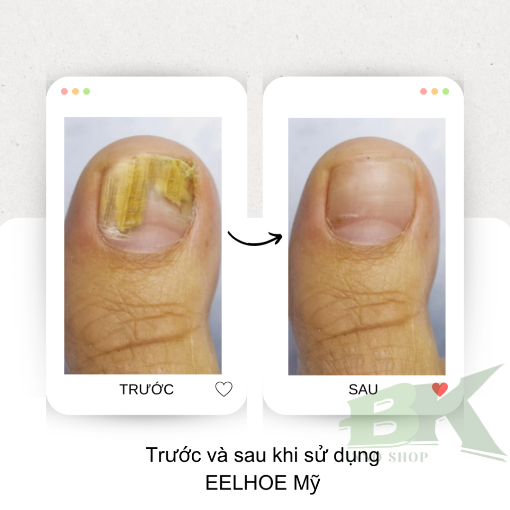 Tinh Chất Diệt Nấm Móng Thảo Dược EELHOE Mỹ Triệt Tiêu Nấm Móng Tay Chân, Dưỡng Móng, Chăm Móng Cứng Chắc Khỏe| BK INNO