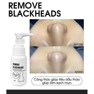 Ủ Mụn Đầu Đen Remove Blackheads
