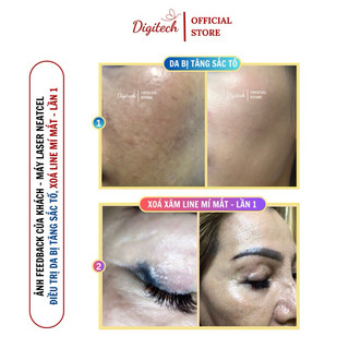 Máy laser Neatcell hỗ trợ làm mờ xăm, giảm nám, xoá nốt ruồi, làm sáng, đều màu da hiệu quả | Phù hợp cho cá nhân & Spa