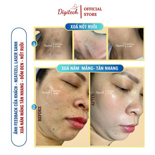 Máy laser Neatcell hỗ trợ làm mờ xăm, giảm nám, xoá nốt ruồi, làm sáng, đều màu da hiệu quả | Phù hợp cho cá nhân & Spa