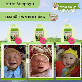 kem bôi da minh hùng