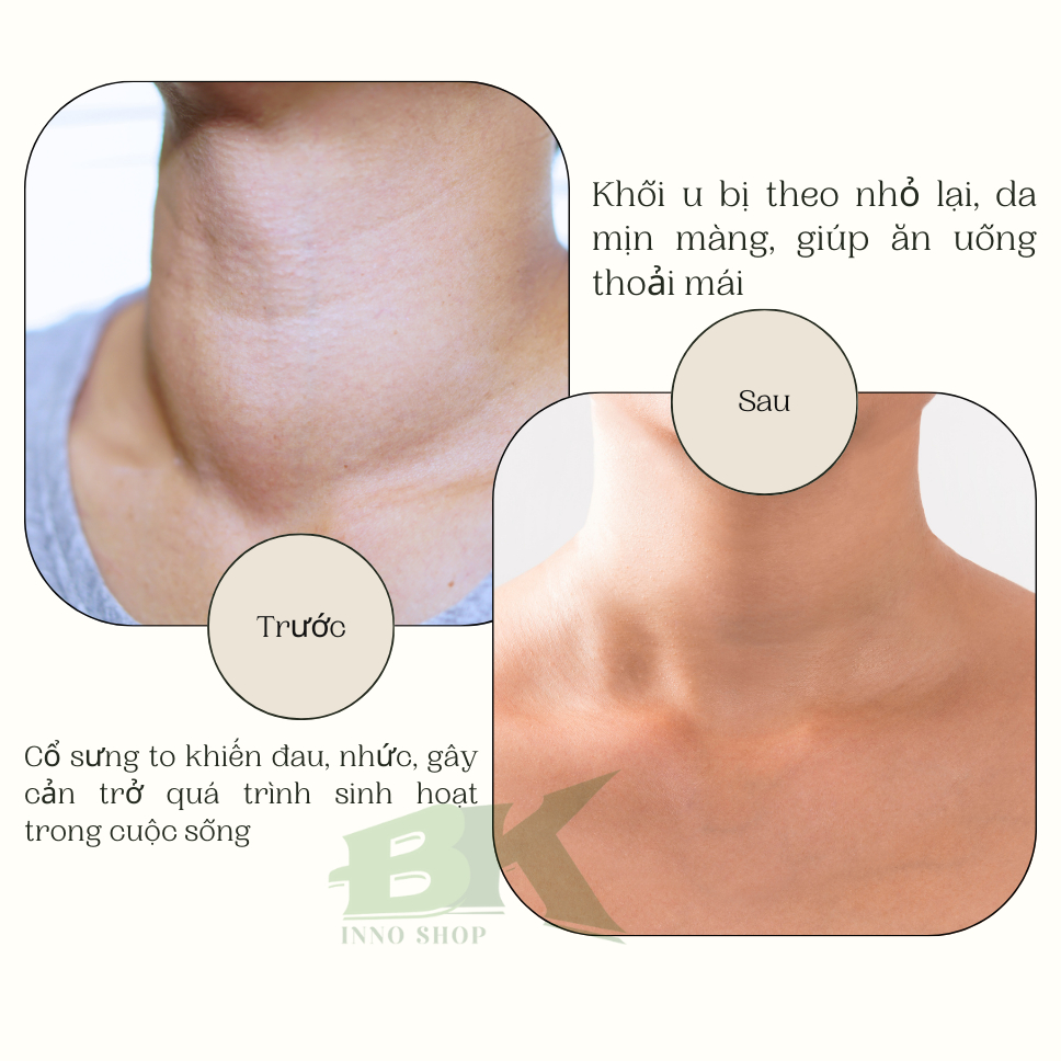 Kem Lăn Massage U Tuyến Giáp Thảo Dược SOUTH MOON 50GR Tiêu U Viêm Tuyến Giáp, Cường Giáp, Bướu Cổ, Basedown | BK INNO