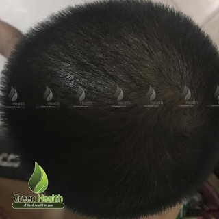 Viên uống DHT Blocker Plus 60 Viên Hỗ Trợ Mọc Tóc, Chặn DHT Dành Cho Nam, Nữ