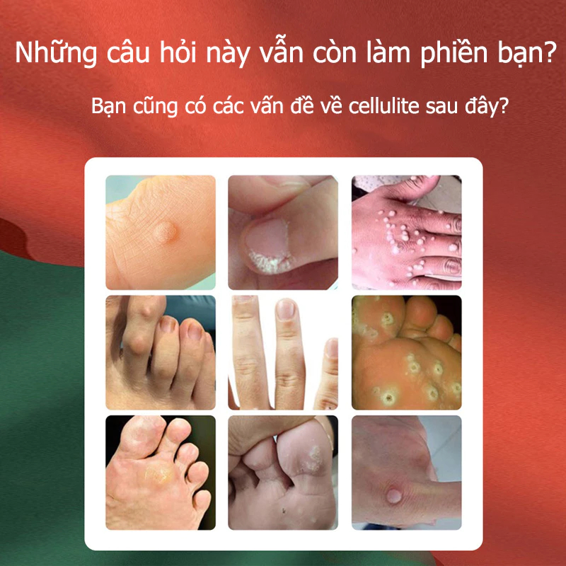 kem xoá mụn cóc 20g Loại bỏ mụn cóc, mụn thịt , loại bỏ mụn cóc thông thường ,mụn đá , mụn cơm ,mụn cóc dạng sợi