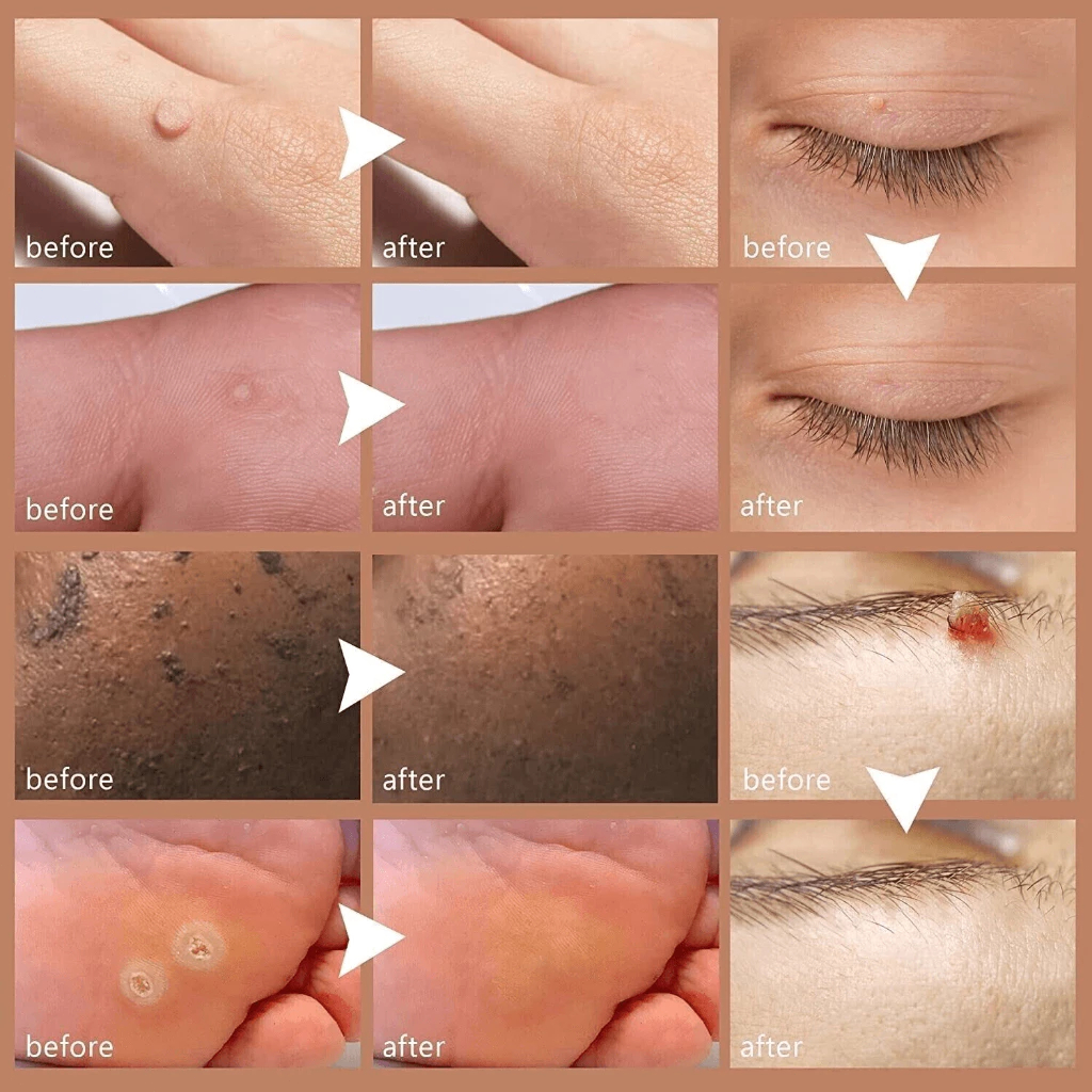 kem xoá mụn cóc 20g Loại bỏ mụn cóc, mụn thịt , loại bỏ mụn cóc thông thường ,mụn đá , mụn cơm ,mụn cóc dạng sợi