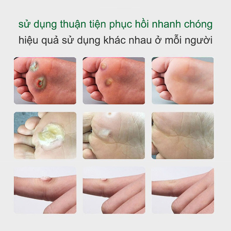 kem xoá mụn cóc 20g Loại bỏ mụn cóc, mụn thịt , loại bỏ mụn cóc thông thường ,mụn đá , mụn cơm ,mụn cóc dạng sợi
