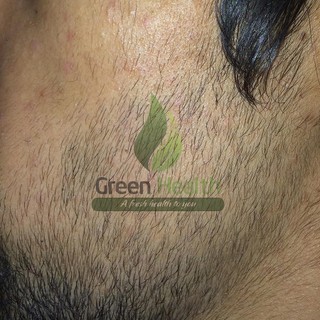 Xịt tóc Minoxidil 5% combo LCLT mọc râu tóc