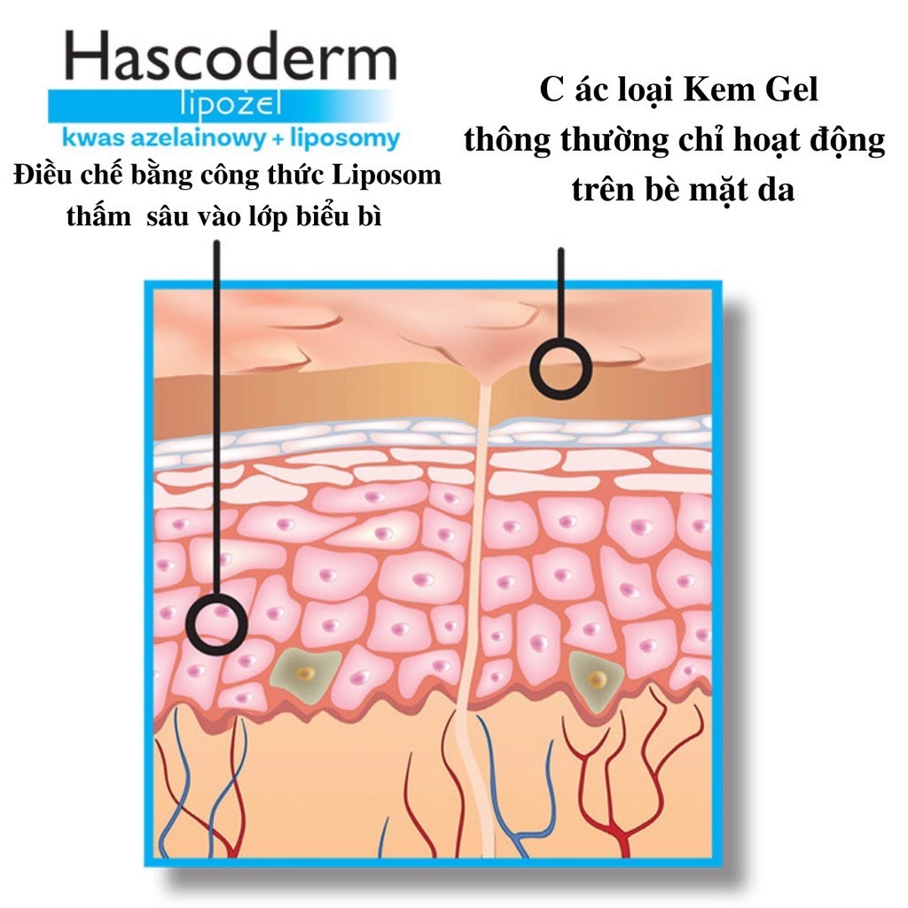 Kem chấm mụn Hascoderm với azelaic acid liposome tác dụng tương tự skinoren acnederm giúp giảm mụn, giảm thâm 30gr