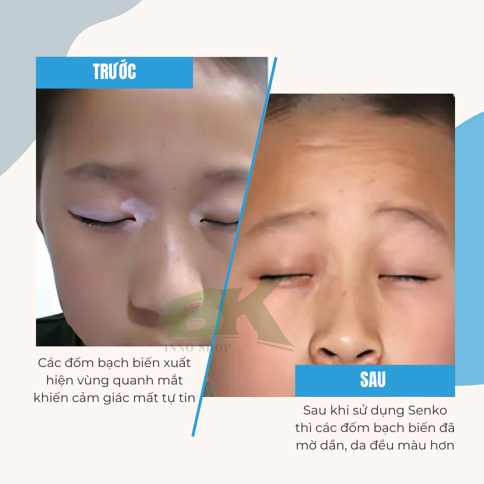 Xịt Bạch Biến Thảo Dược Cổ Truyền Nhật Bản SENKO Giảm Đốm Trắng Bạch Biến, Hắc Lào, Lang Ben, Viêm Da Cơ Địa | BK INNO