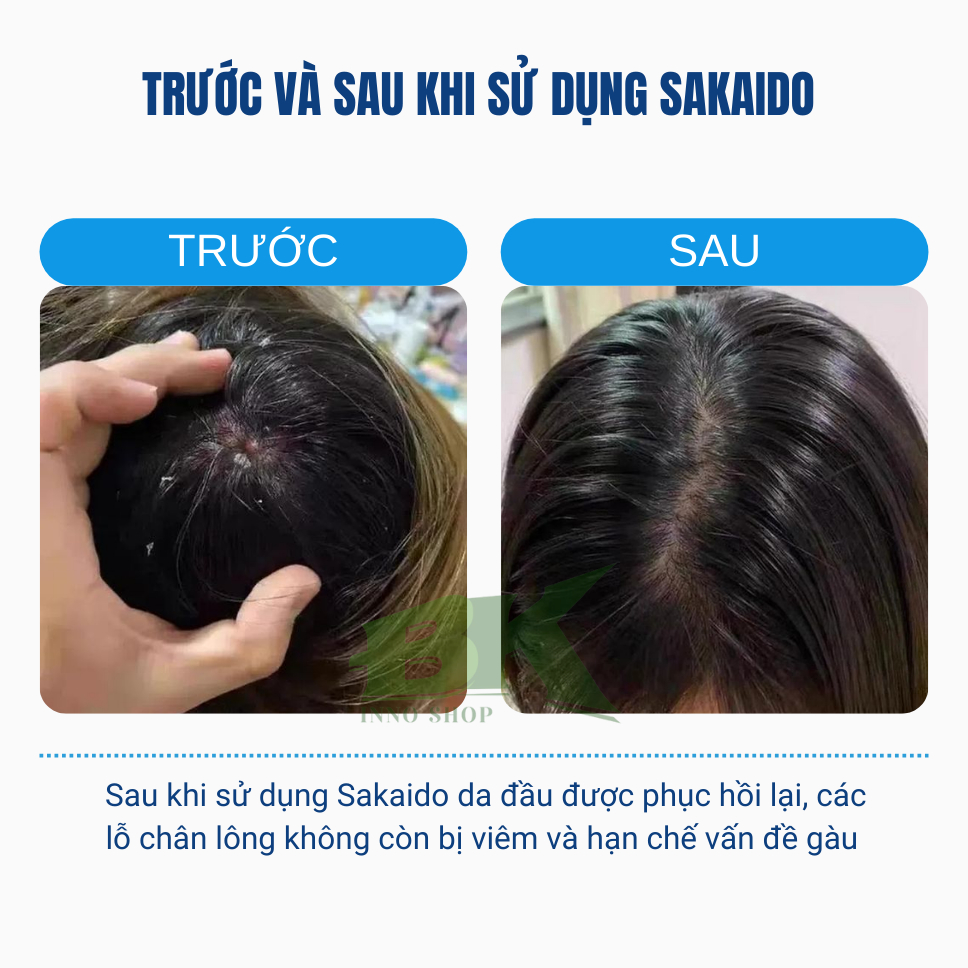 Kem Bôi Viêm Nang Tóc, Nang Lông Thảo Dược SAKAIDO Hỗ Trợ Giảm Các Ổ Viêm Nang, Sạch Gàu, Thông Thoáng Da Đầu | BK INNO