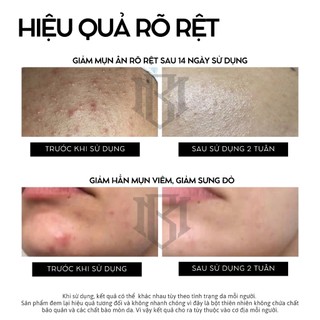 𝐁𝐎̣̂𝐓 𝐊𝐇𝐎̂̃ 𝐐𝐔𝐀 𝐑𝐔̛̀𝐍𝐆 - bột khổ qua rừng giảm mụn sáng da, bột thiên nhiên đắp mặt Mitty Beaute