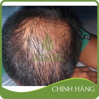 Dung dịch mọc râu tóc Tugain 60ml