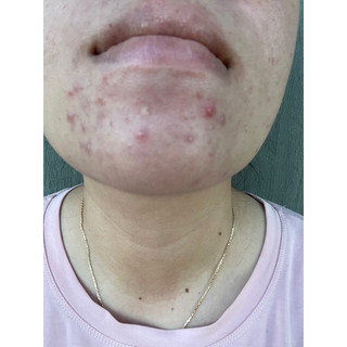 (TẶNG SỮA RỬA MẶT) Kem hỗ trợ cải thiện mụn, thâm, đều màu da Hoa Đào 8gr, tặng sữa rửa mặt dịu nhẹ Hoa Đào 30ml