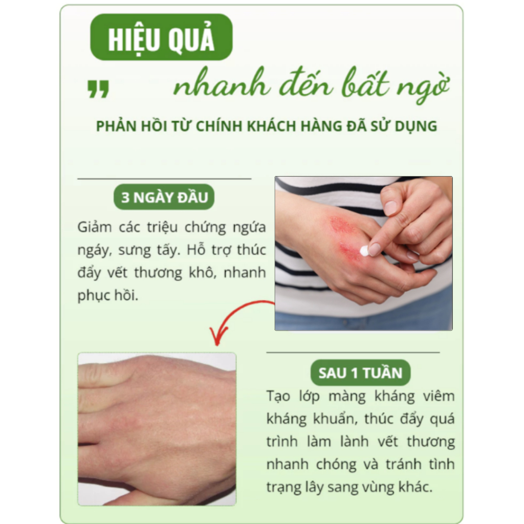 Kem bôi cao cấp Bakazona - Gel bôi thảo mộc Bakazona - Giảm độc tố do côn trùng cắn, giảm viêm da cơ địa - QUINN BEAUTY