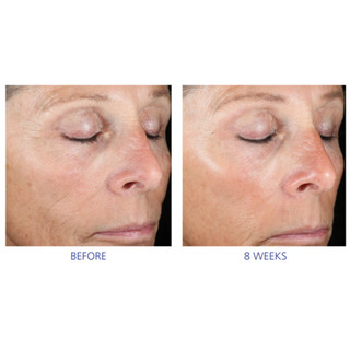 IS CLINICAL ACTIVE PEEL SYSTEM (DATE 9.2025)