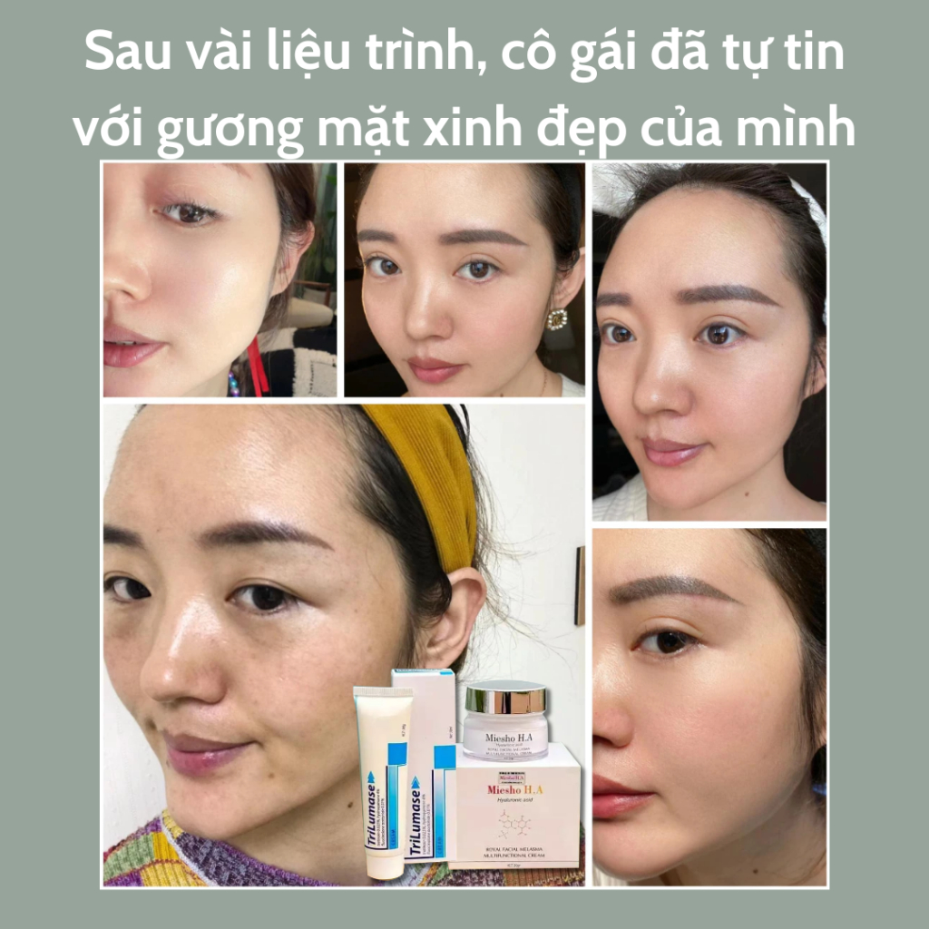 Combo giảm nám tàn nhang MIESHO H.A & TR.ILUMASE - Phục hồi nám tàn nhang MIESHO H.A & TR.ILUMASE - QUINN BEAUTY STORE