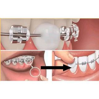 SÁP NHA KHOA, SÁP NIỀNG RĂNG SET 5 HỘP SÁP NHA KHOA