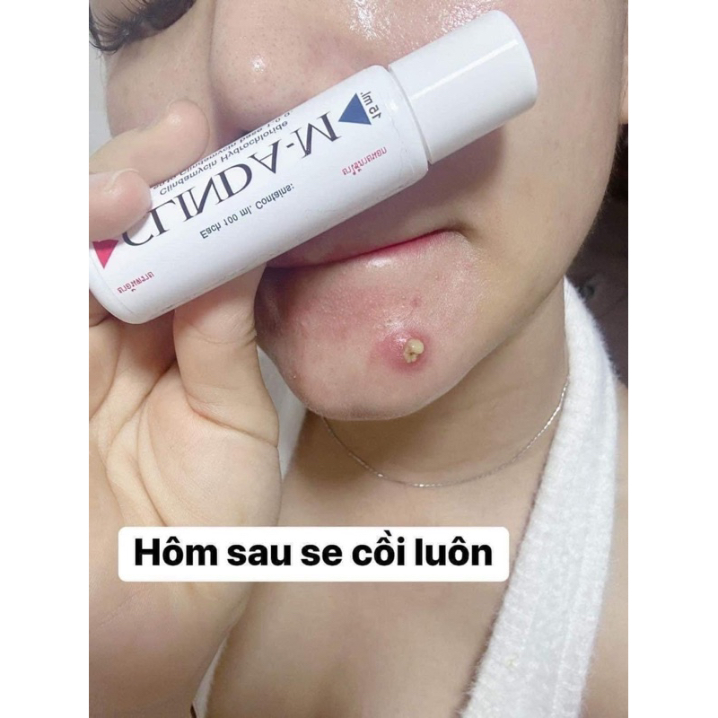(da.te 07/25 )thanh lý Gel chấm mụn CLINDA-M Thái