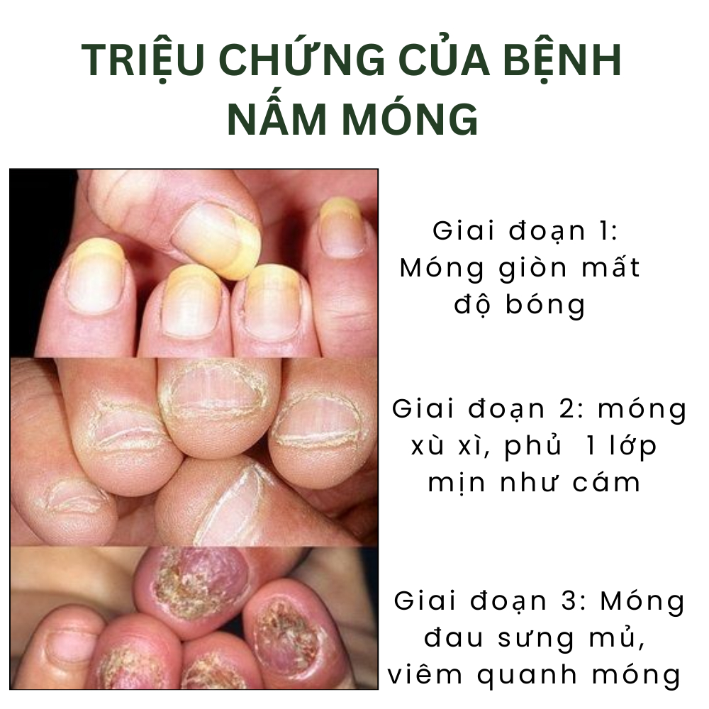 TINH CHẤT LOẠI BỎ NẤM MÓNG CHÂN TAY GINGER EELHOE 7 NGÀY 50ML, SERUM XỬ LÍ TRIỆT ĐỂ NẤM MÓNG, THỐI MÓNG| Moska Shop