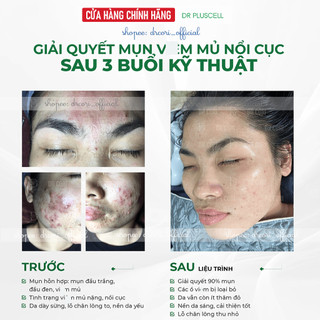 Siêu phẩm tế bào gốc mụn thần tốc Dr Pluscell_ Serum Hàn Quốc