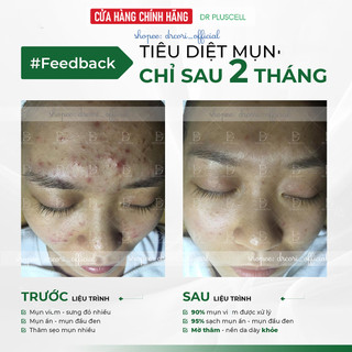 Siêu phẩm tế bào gốc mụn thần tốc Dr Pluscell_ Serum Hàn Quốc